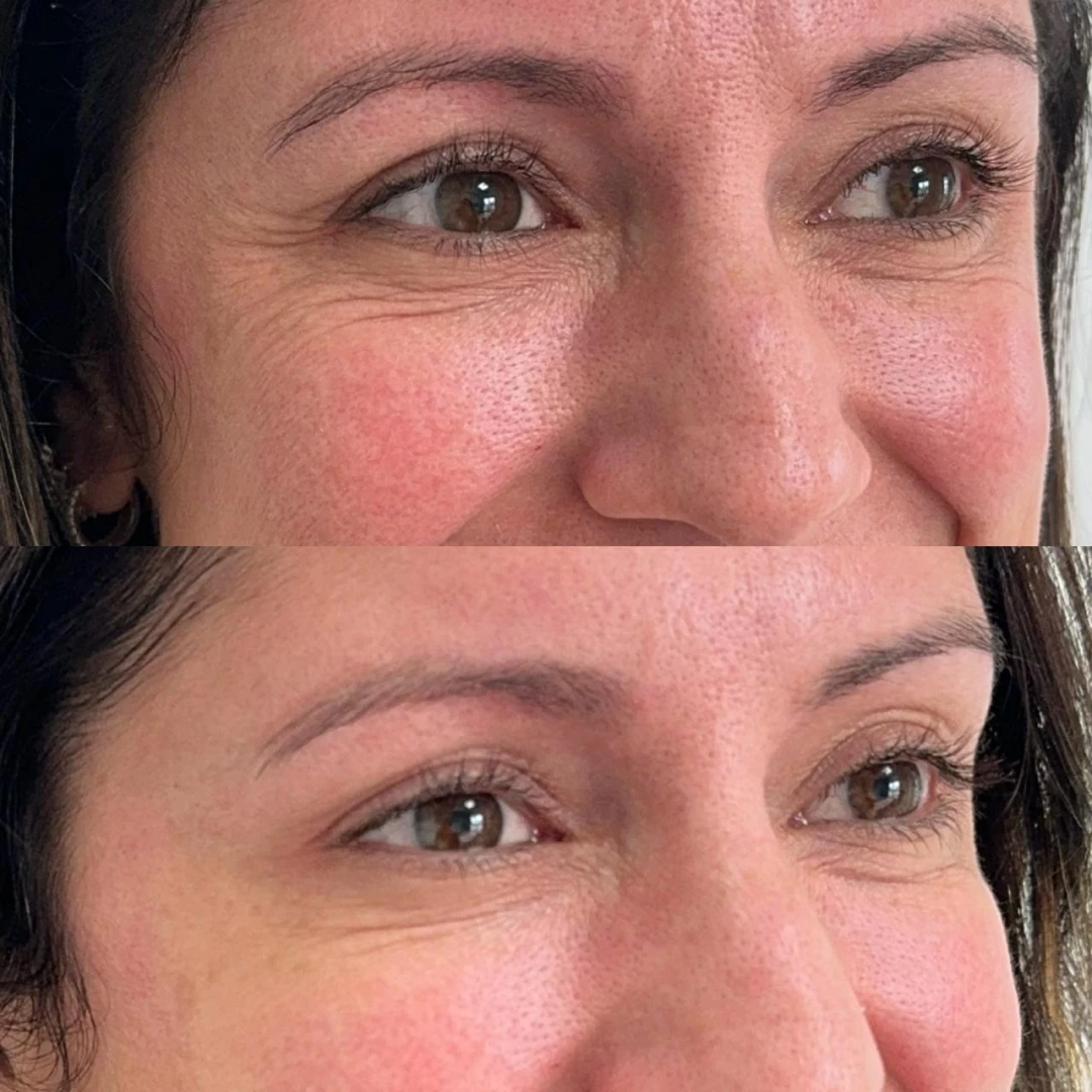 Botox (1)