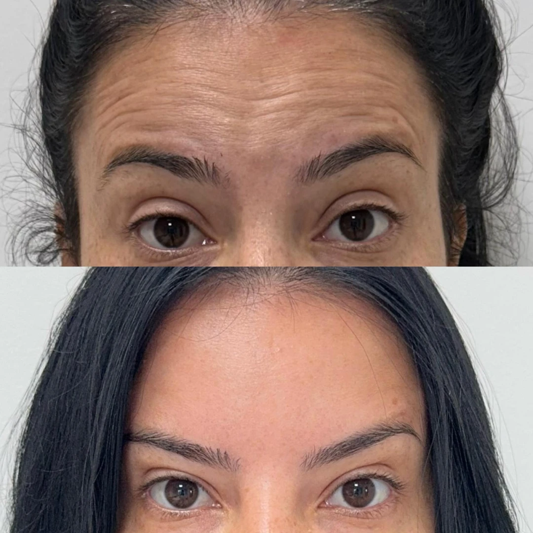 Botox (10)