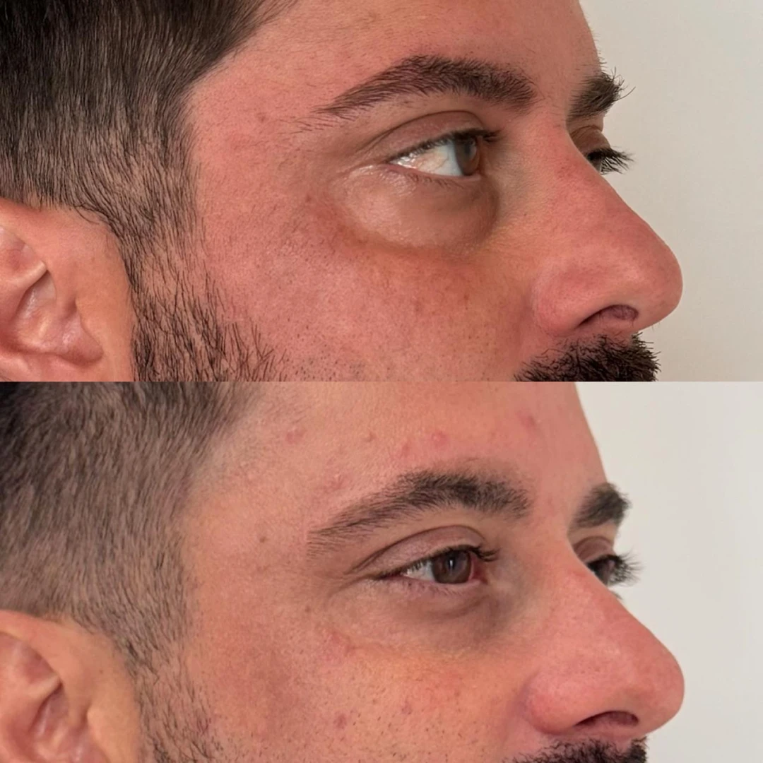 Botox (11)