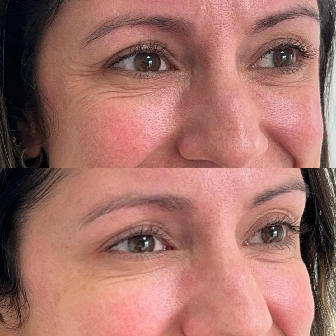 Botox (12)