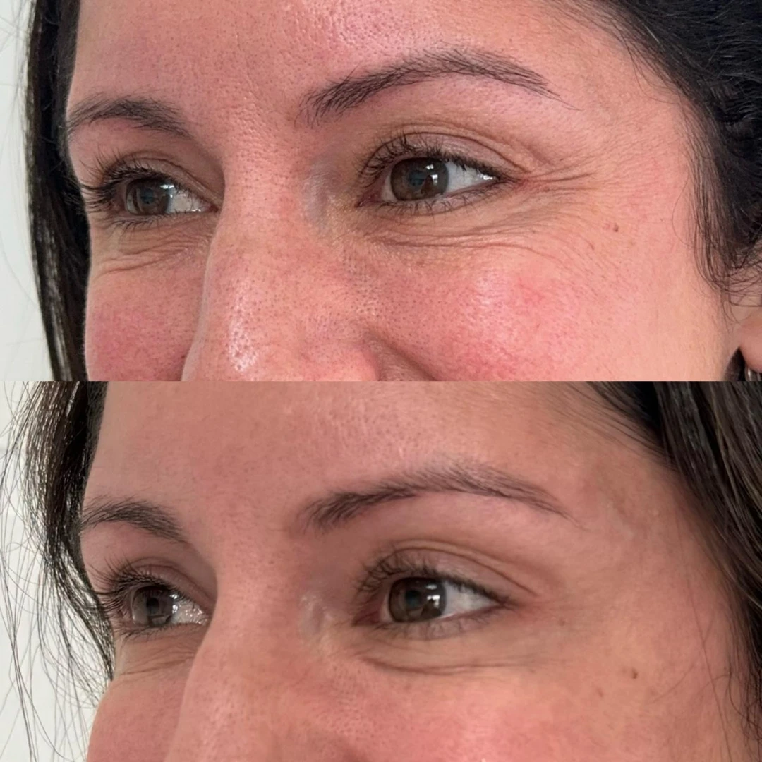 Botox (13)