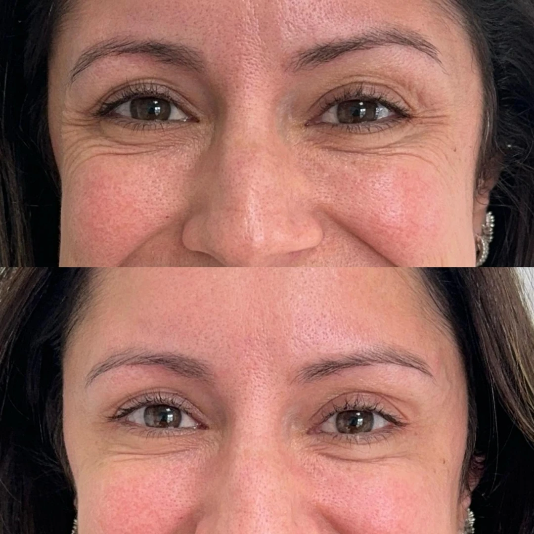 Botox (14)