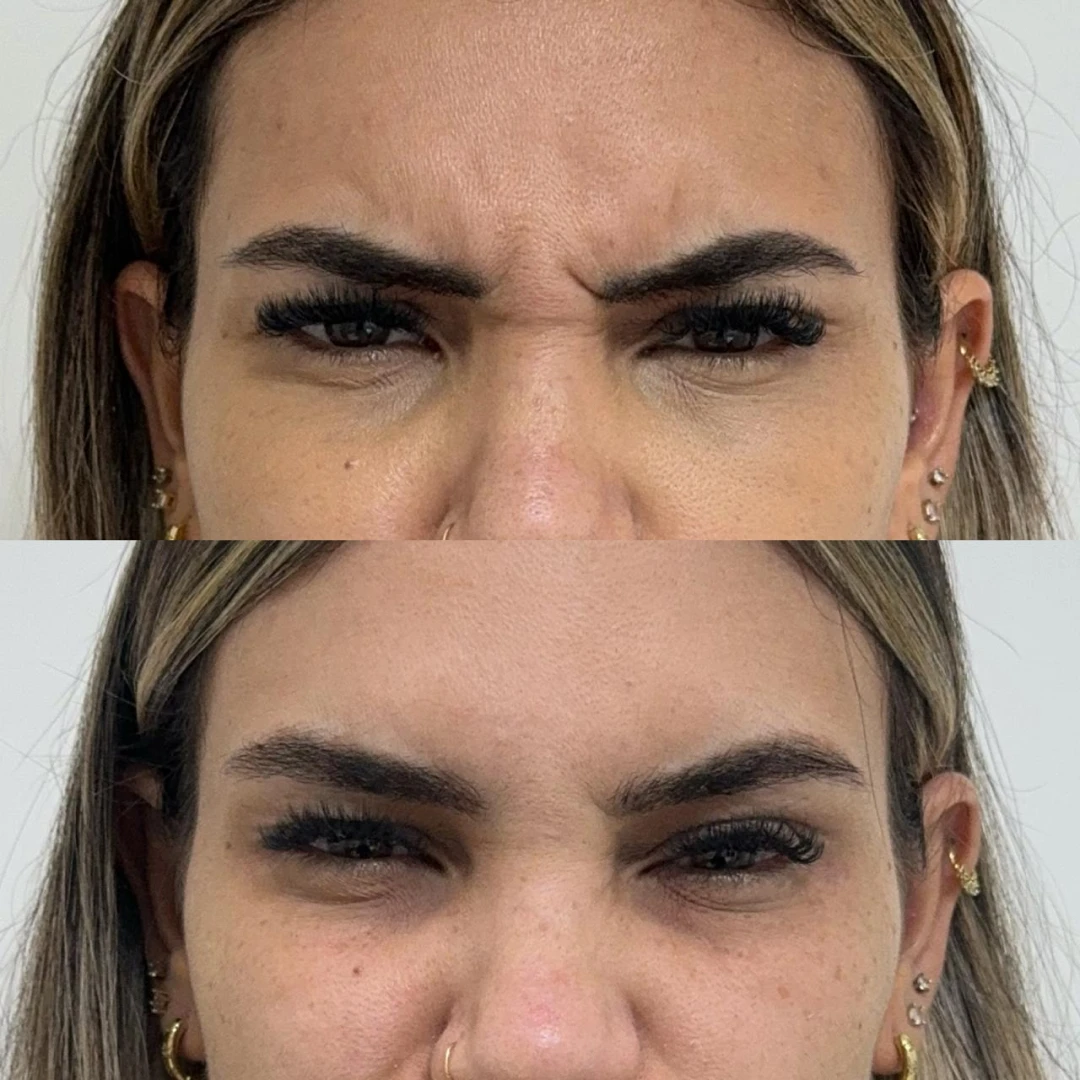 Botox (16)