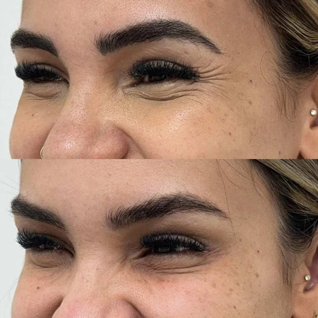 Botox (17)