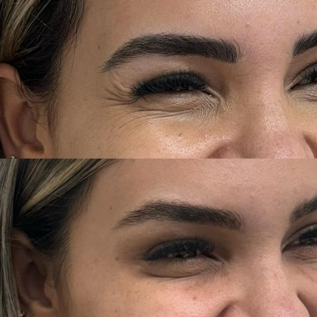 Botox (18)