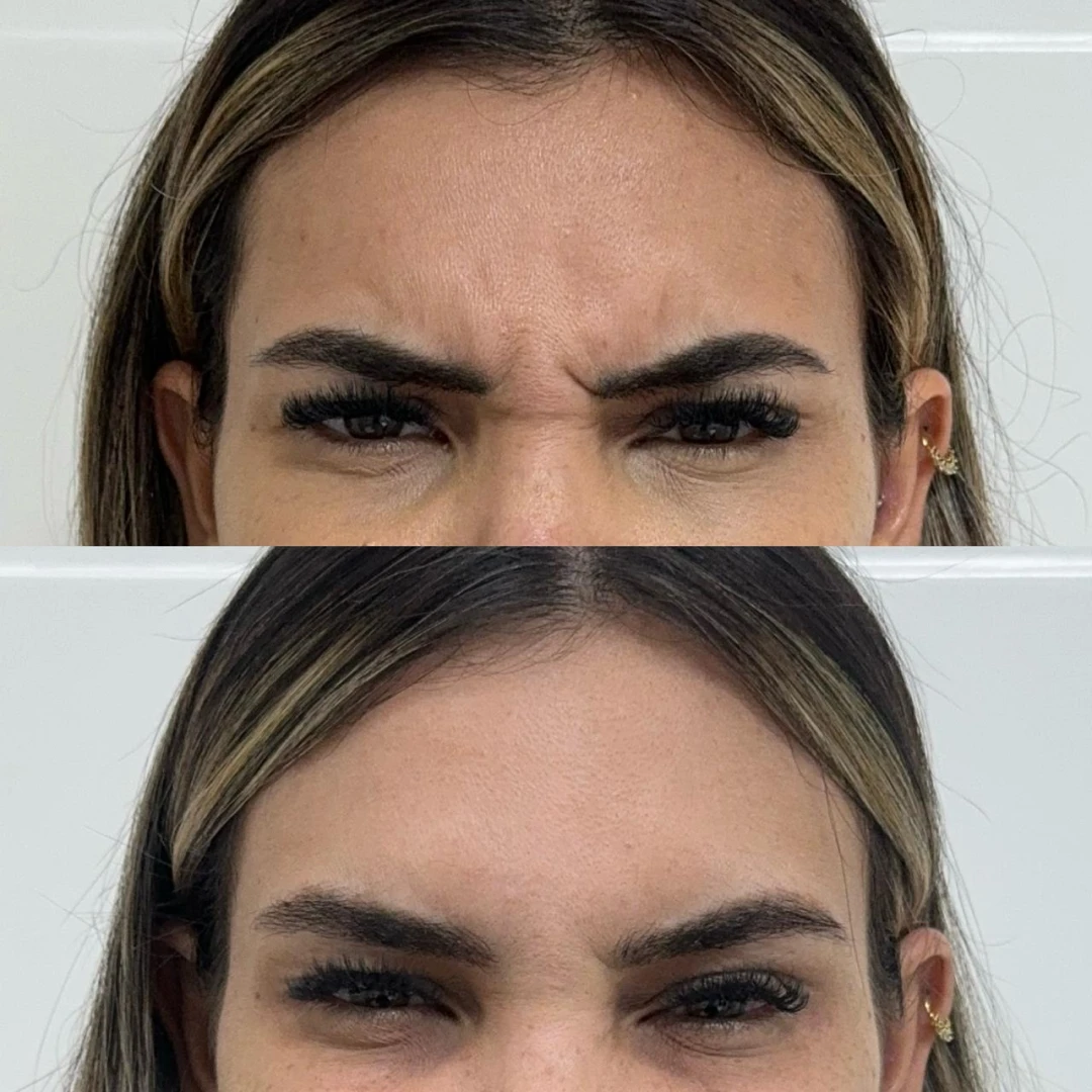Botox (19)