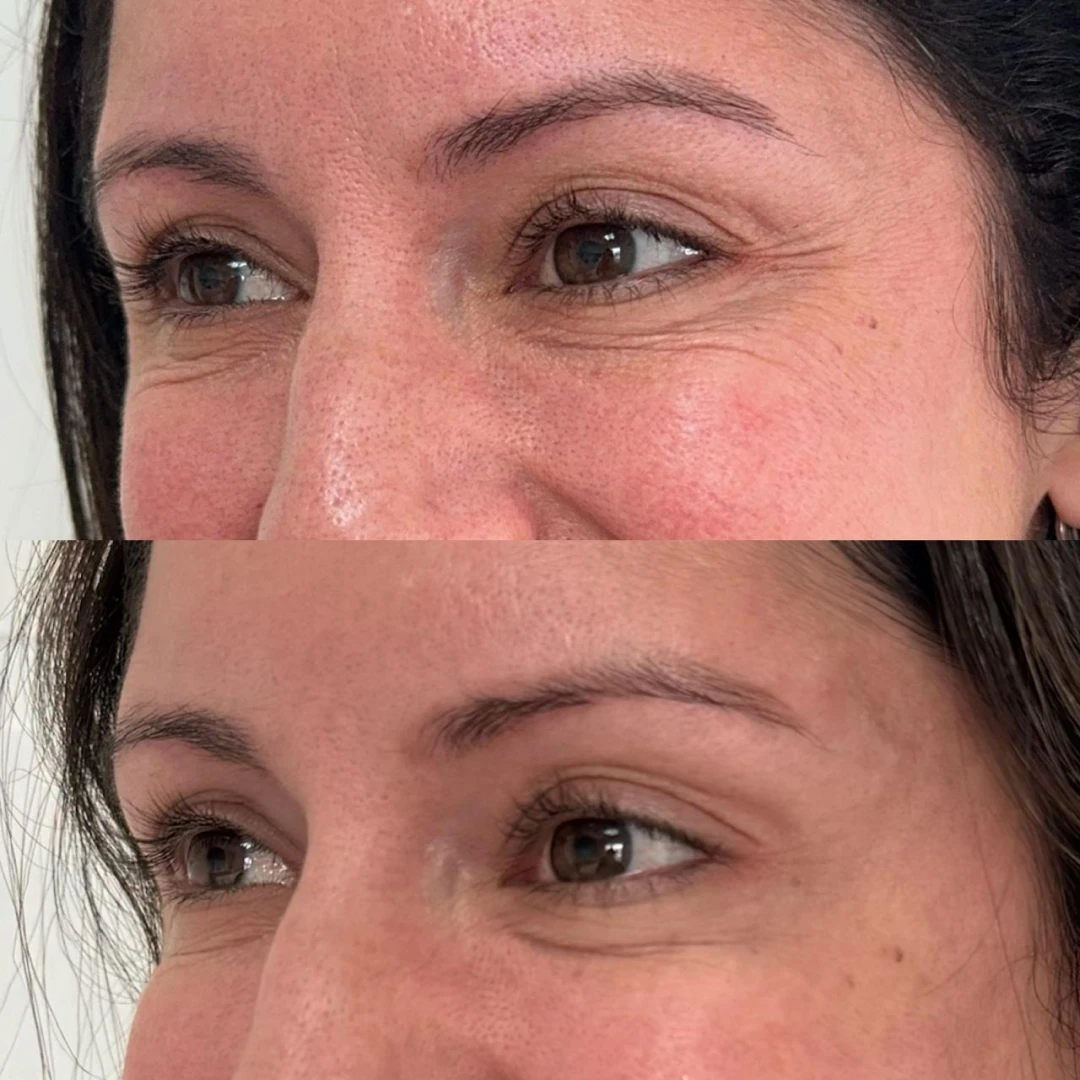 Botox (2)