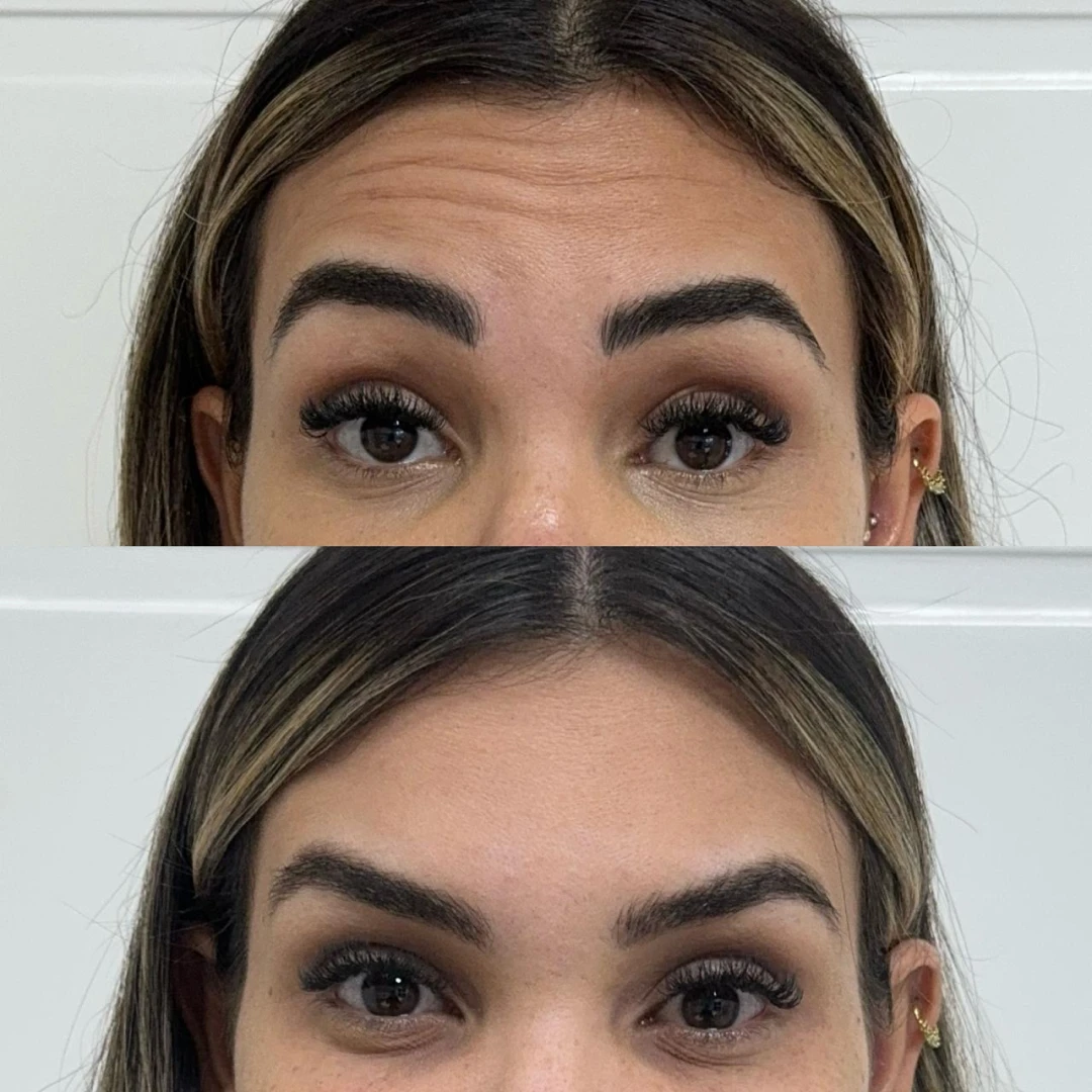 Botox (20)