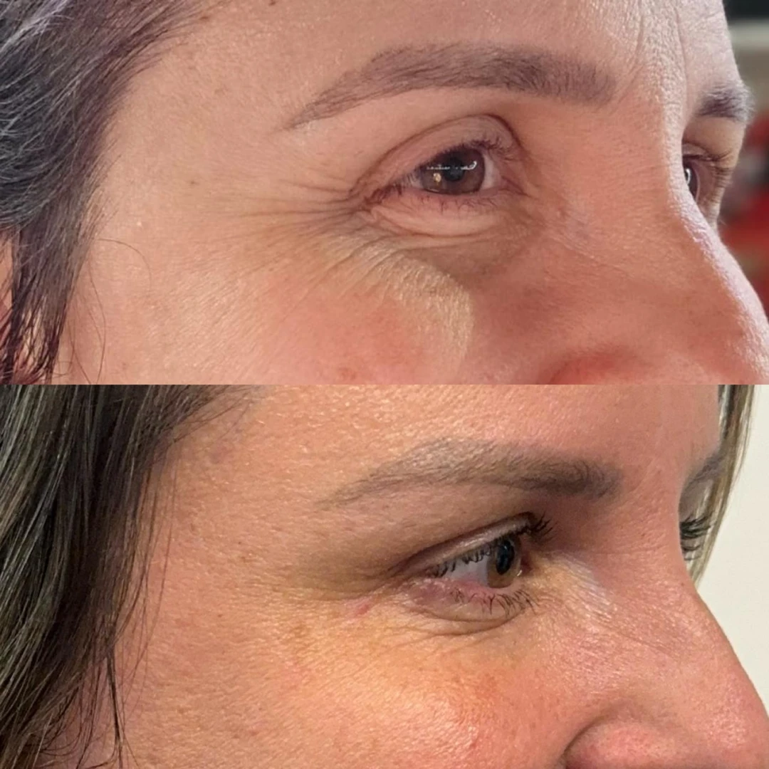 Botox (21)