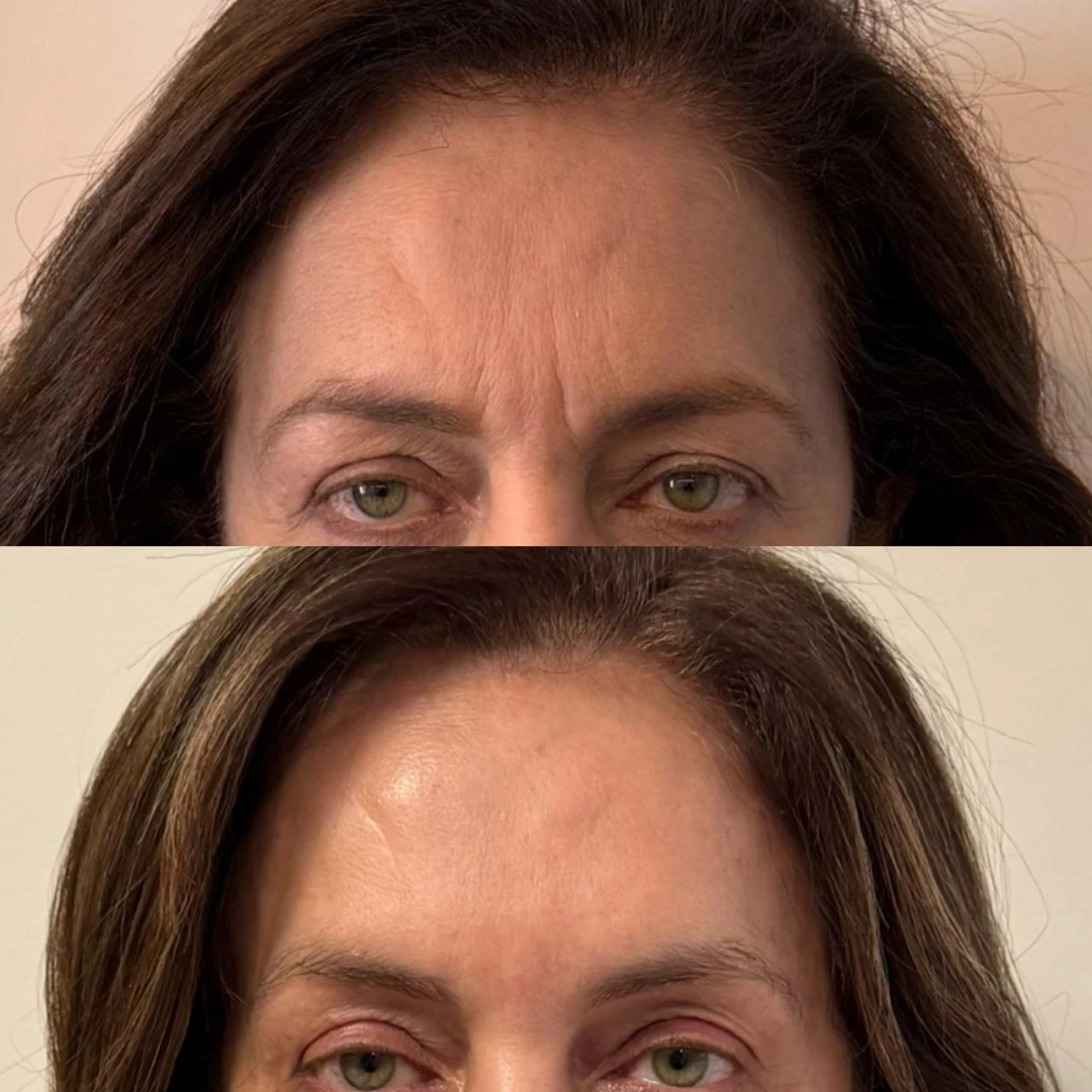 Botox (22)