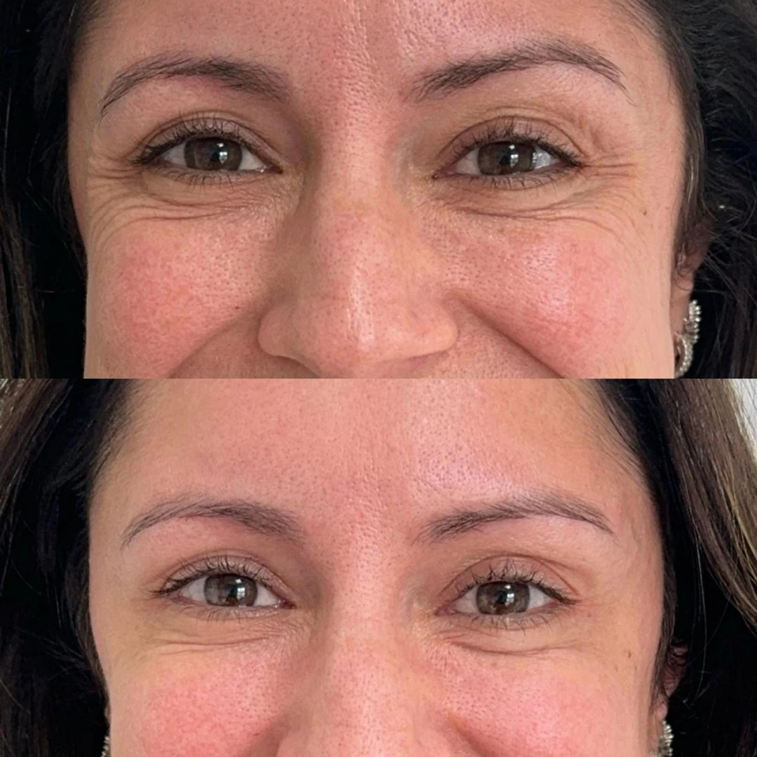 Botox (3)