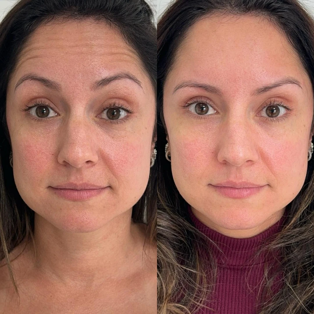 Botox (4)
