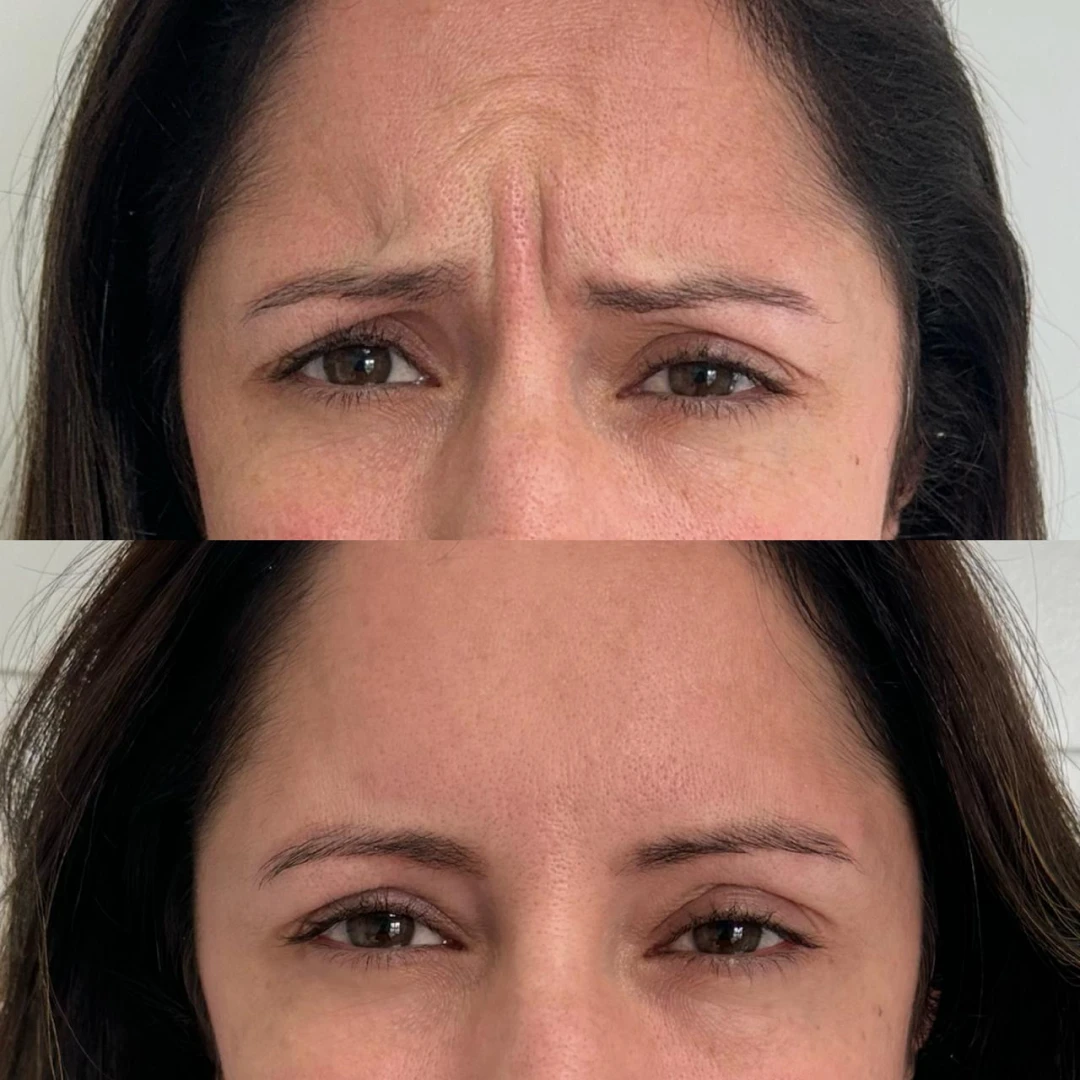Botox (5)