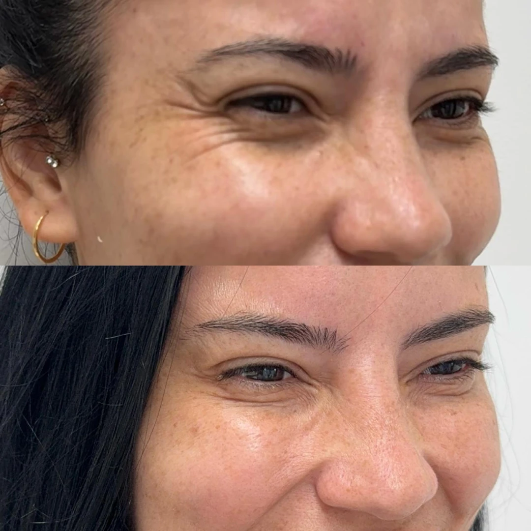 Botox (6)