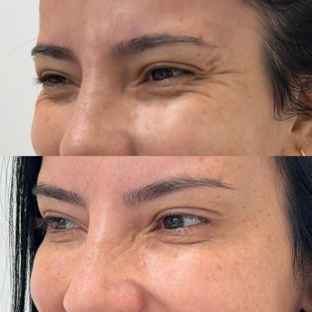 Botox (8)
