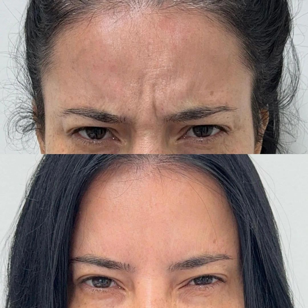 Botox (9)