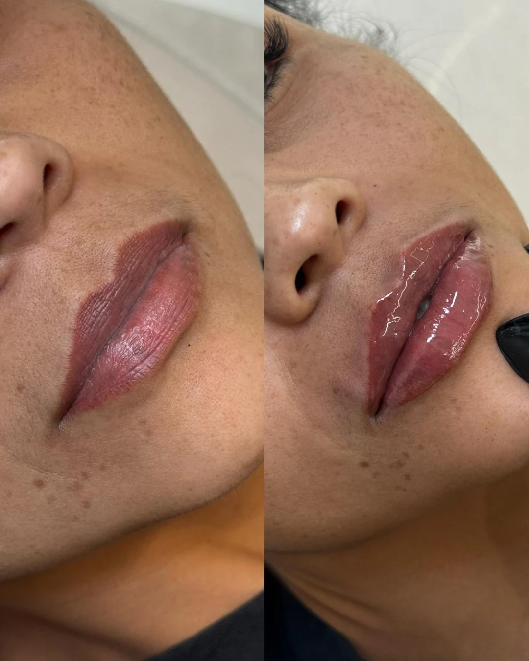 Preenchimento Labial (1)