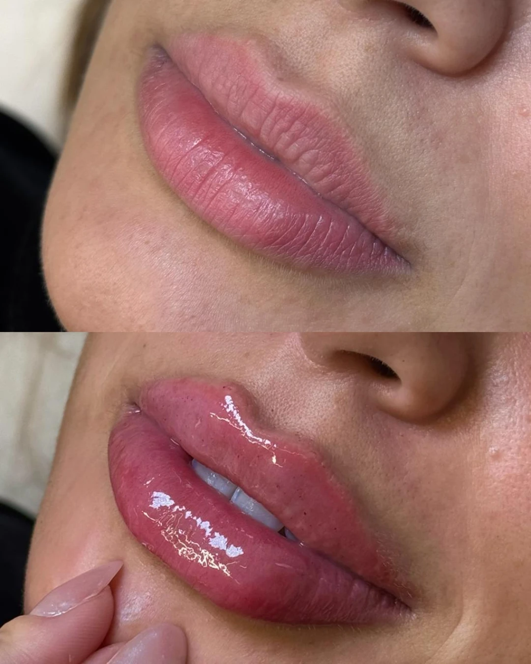 Preenchimento Labial (2)