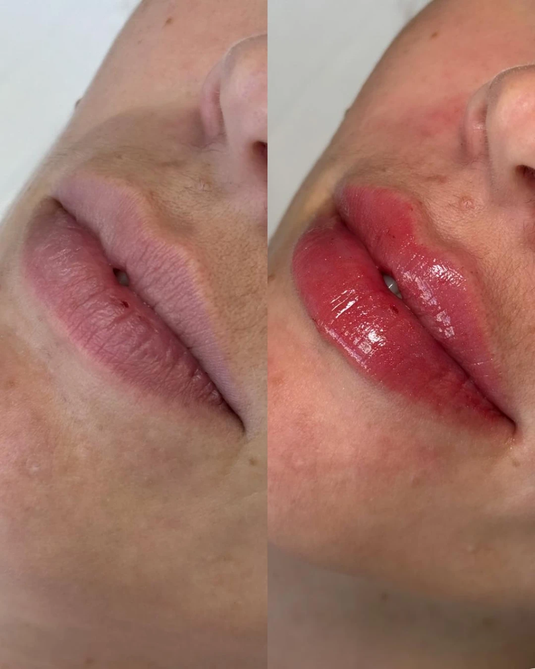 Preenchimento Labial (3)