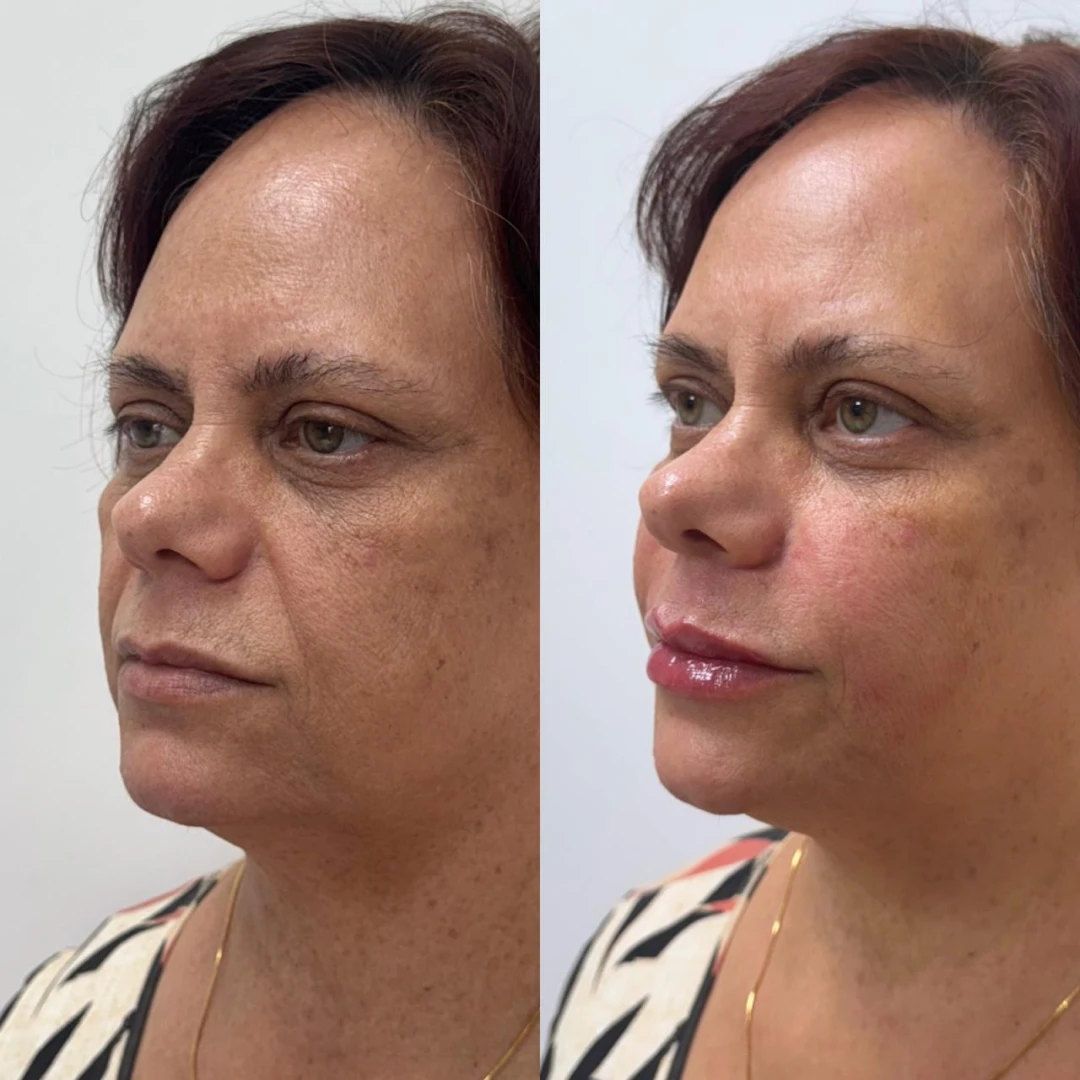Preenchimento Labial (4)