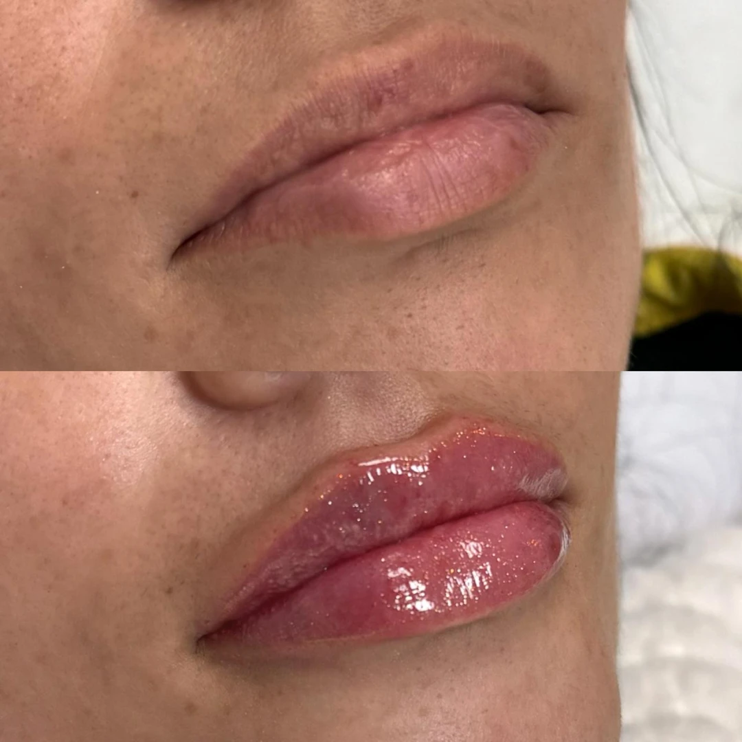 Preenchimento Labial (5)