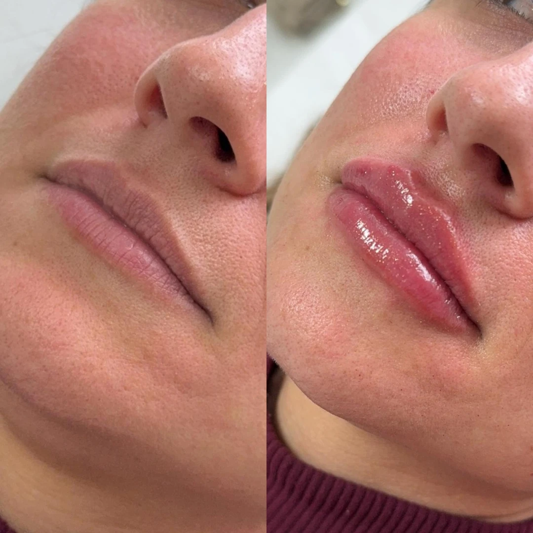 Preenchimento Labial (6)