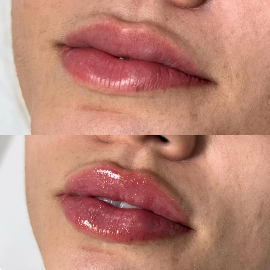 Preenchimento Labial (7)
